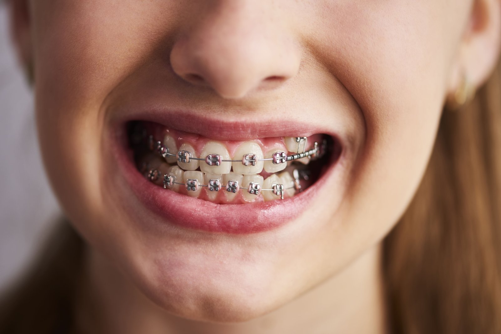 Braces & Aligners